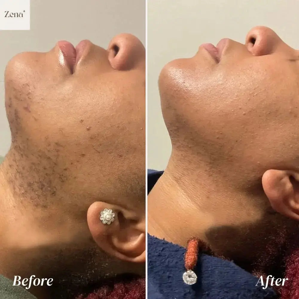 Painless Hair Removal Cream for Face